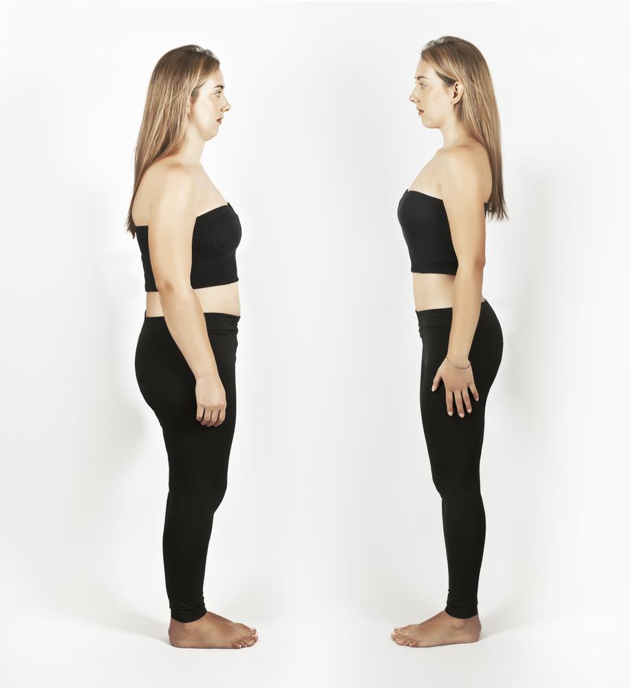 SculpSure Before and After Image