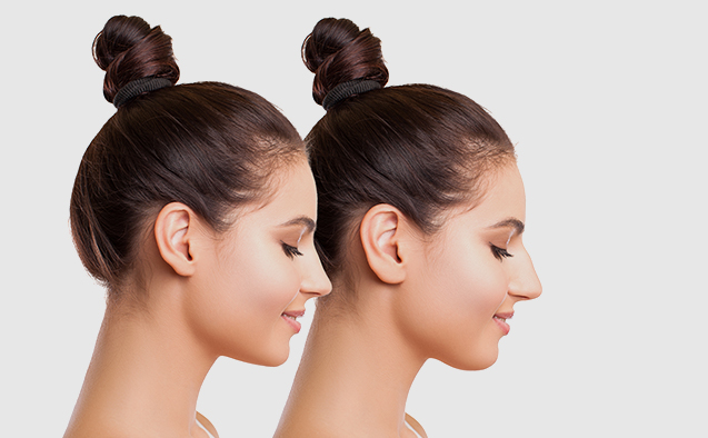 Rhinoplasty for Breathing Problems: Enhancing Quality of Life Through Improved Airflow