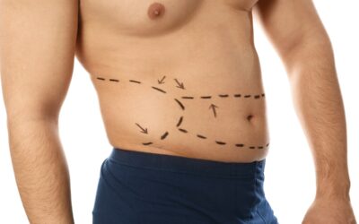 Is It Safe to Get Tummy Tuck Surgery?