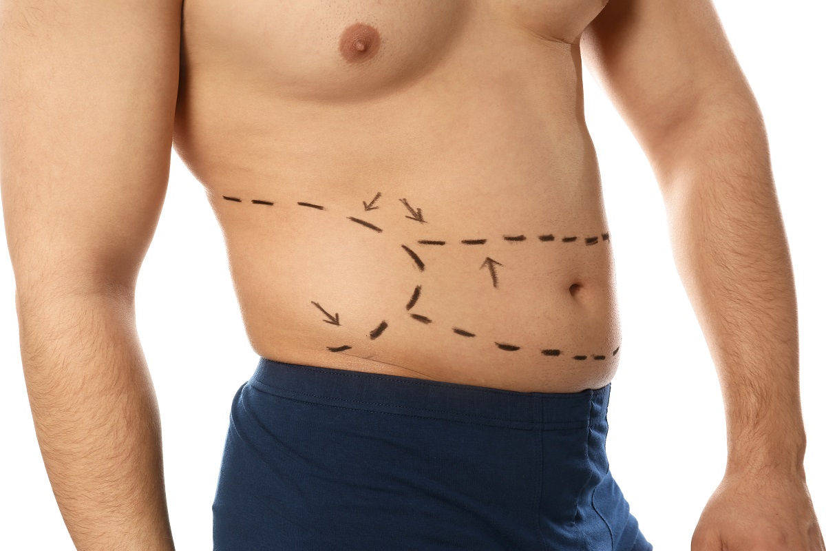 Young man with marks on belly for cosmetic surgery operation