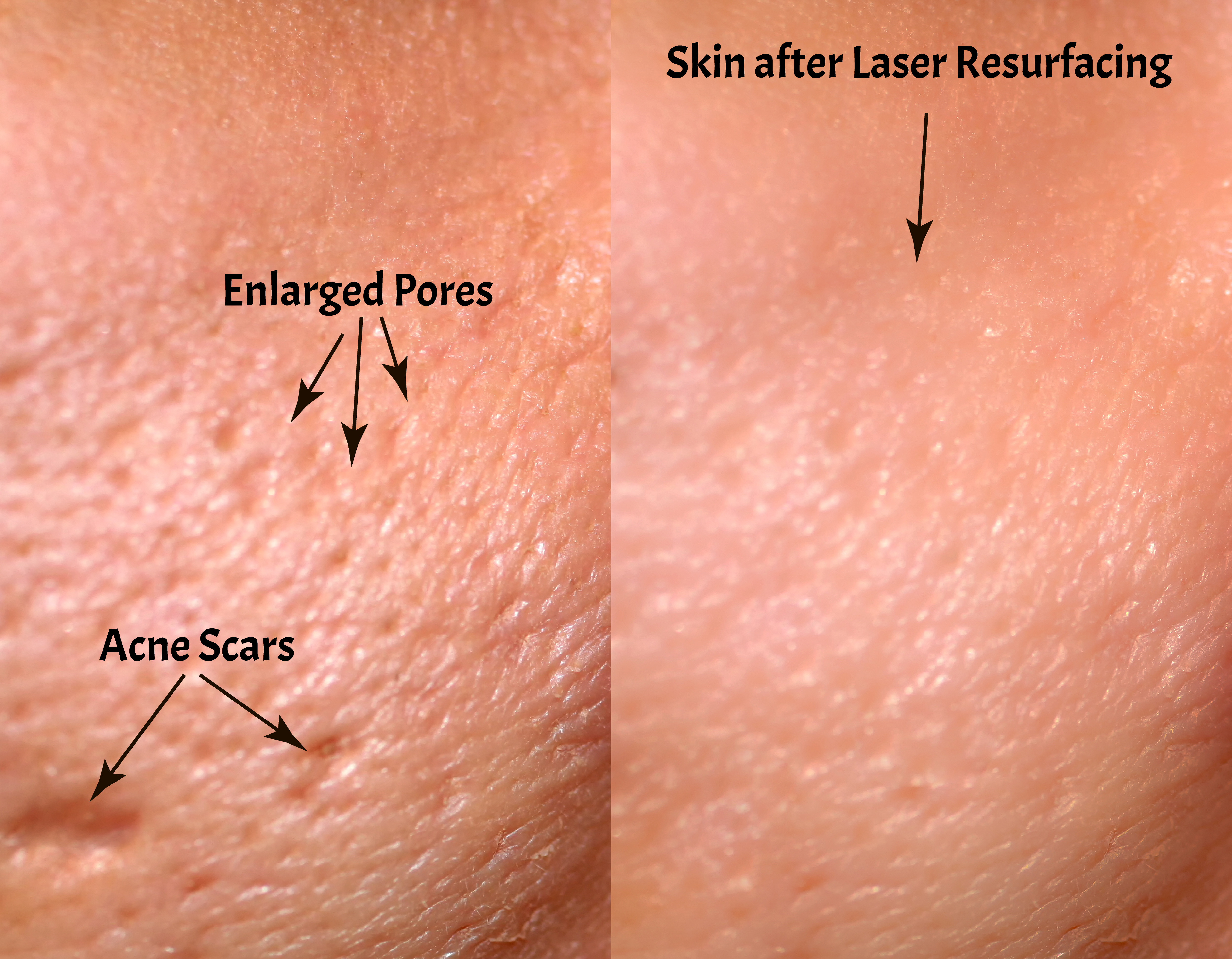 Comparison of skin before and after laser resurfacing