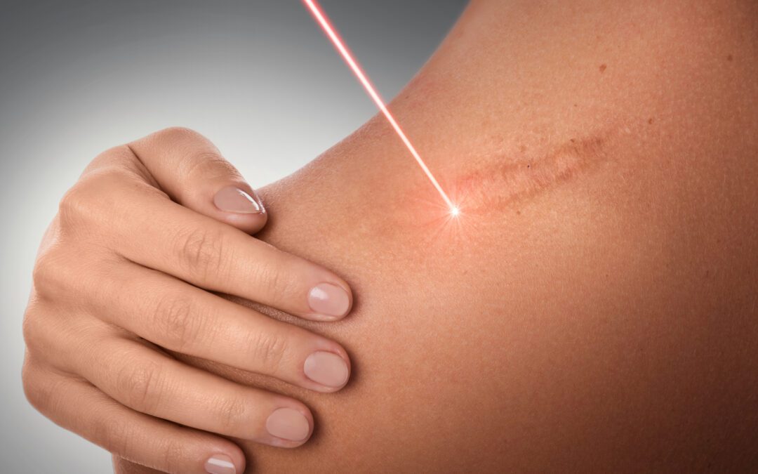 Types of Scars and Laser Skin Treatments and Other Treatment Options