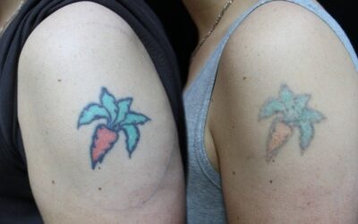 What Is the Process for Laser Tattoo Removal?