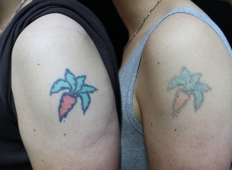 What Is the Process for Laser Tattoo Removal?