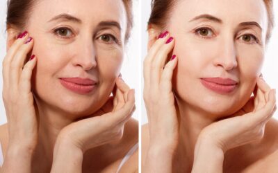 What Can I Expect from a Facelift Procedure?