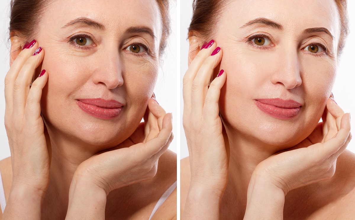 Middle age woman happy face before after cosmetic procedures