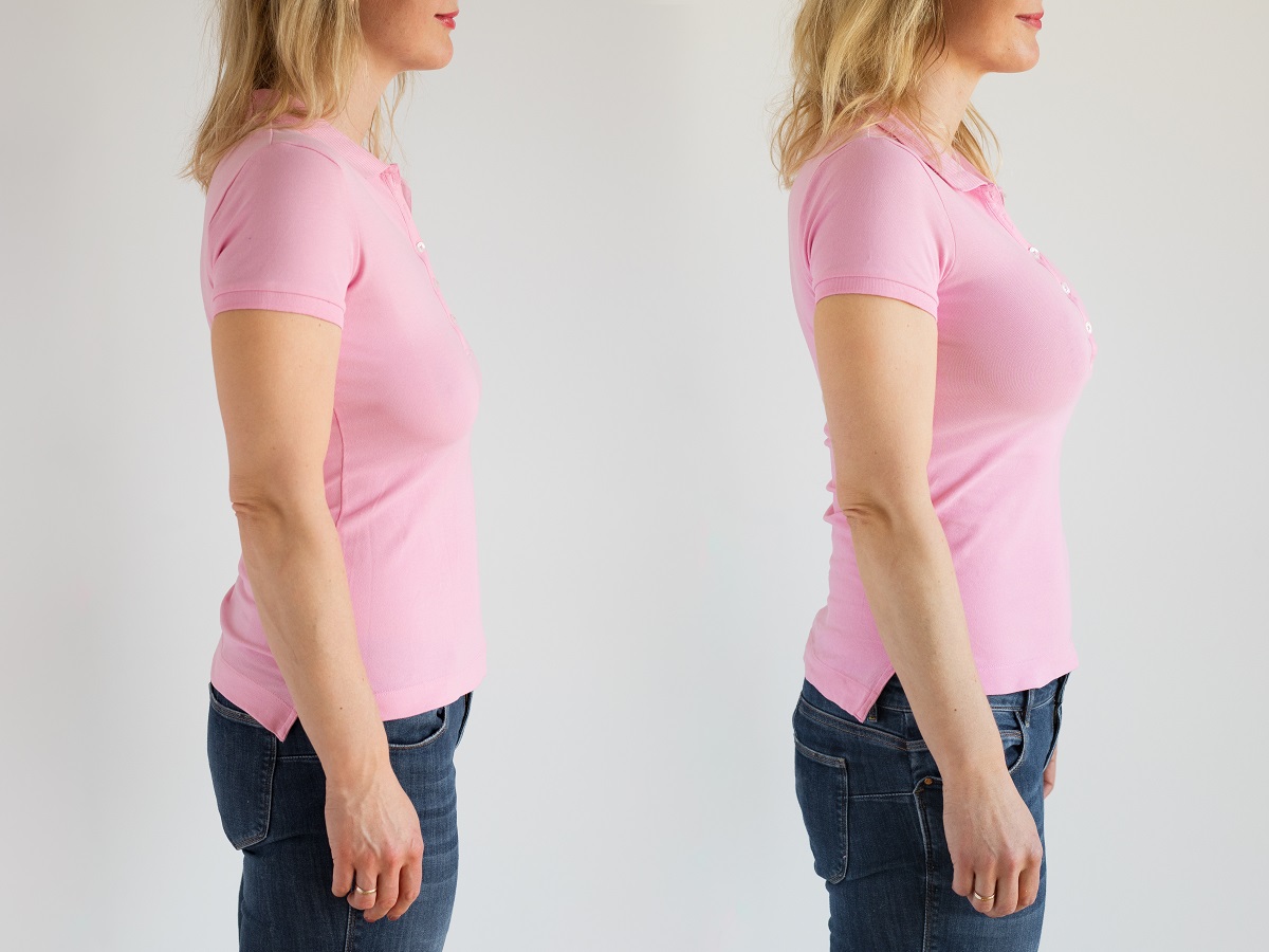 woman before and after breast lift enhancement and augmentation with implants surgery