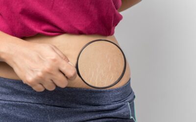 Tips for Preventing and Reducing Stretch Marks