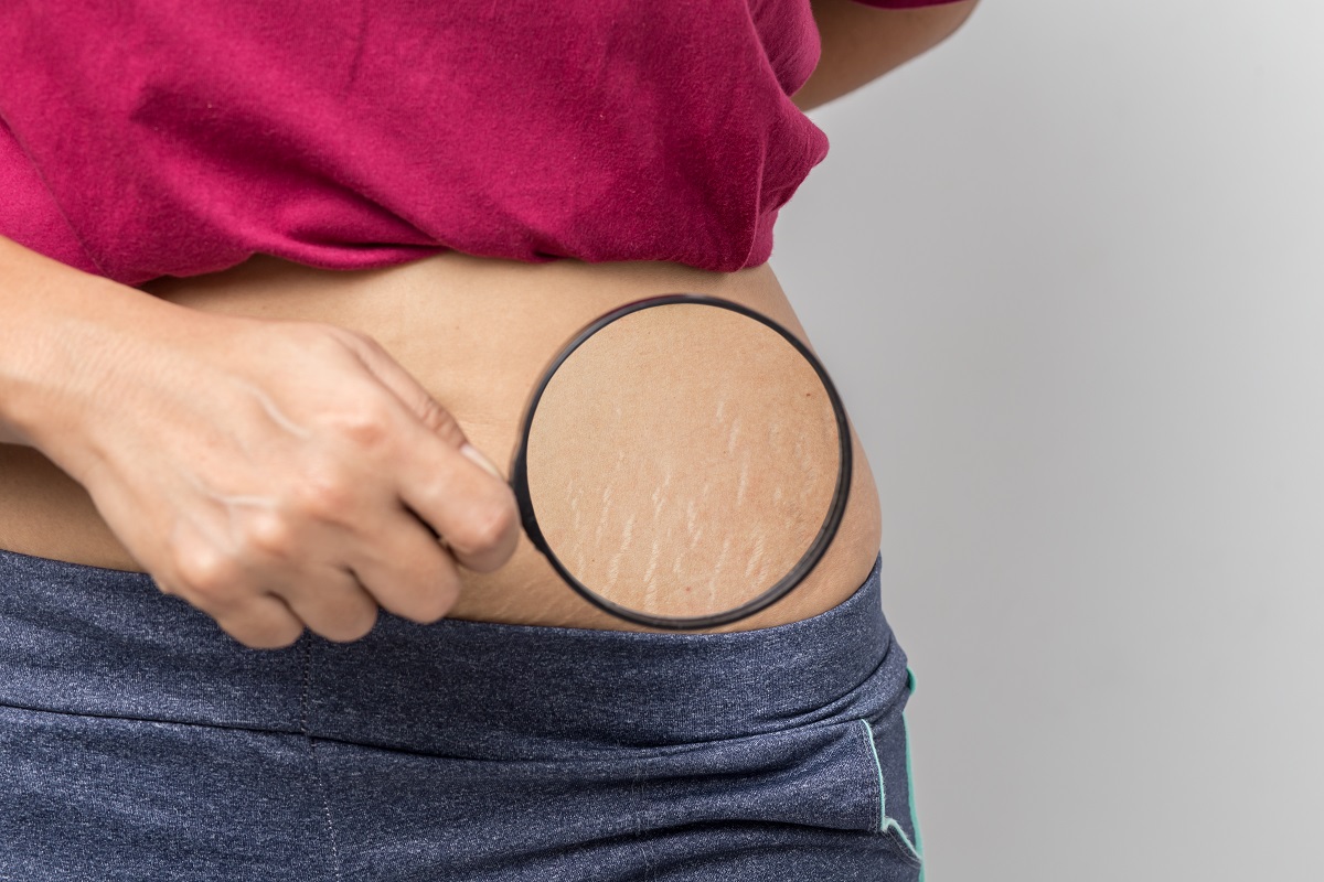 Women Show off the belly's Stretch Marks on white background