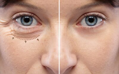 What Is Blepharoplasty Surgery?