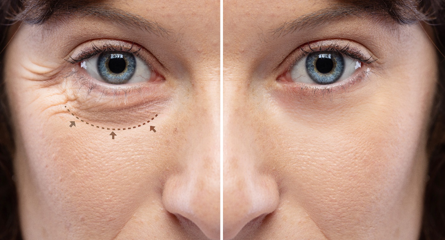 wrinkles and crow's feet removal Lines and arrows shows blepharoplasty zone