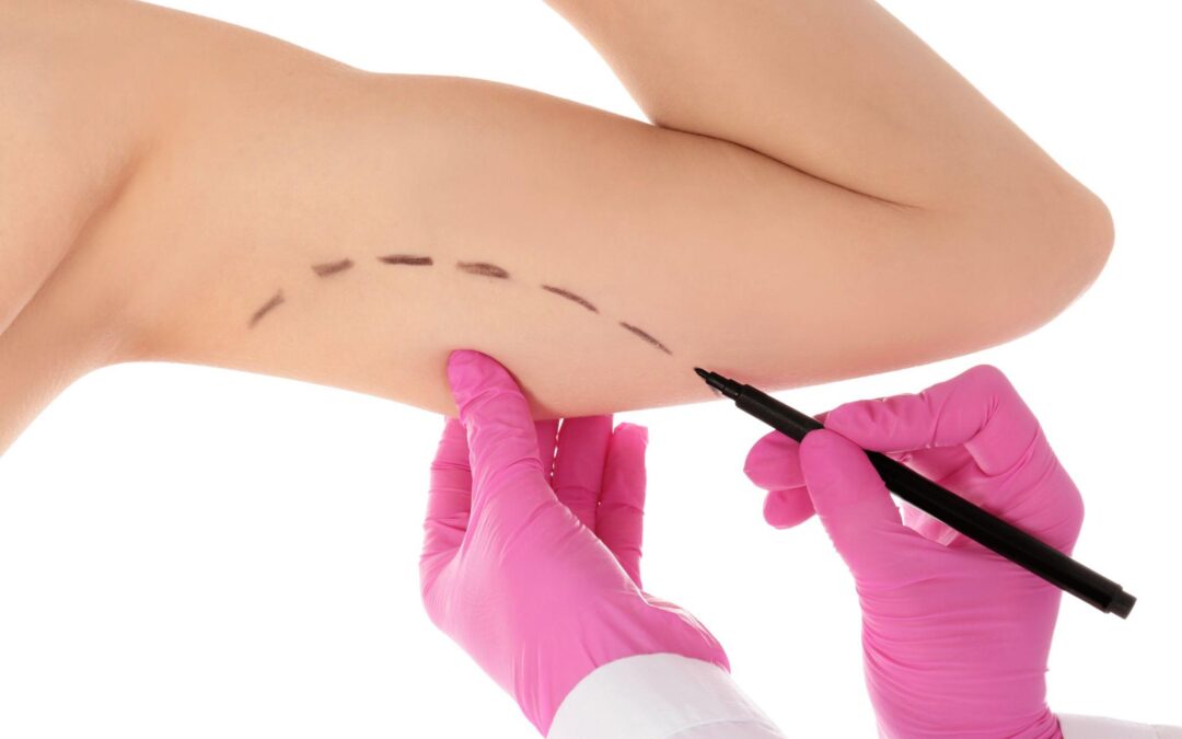 What is a Brachioplasty and How Can This Plastic Surgery Procedure Transform My Life?