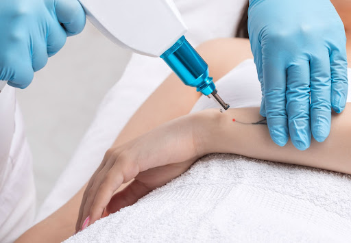 4 Things to Ask When Seeking Laser Tattoo Removal Near Me in West Hills and All of Los Angeles