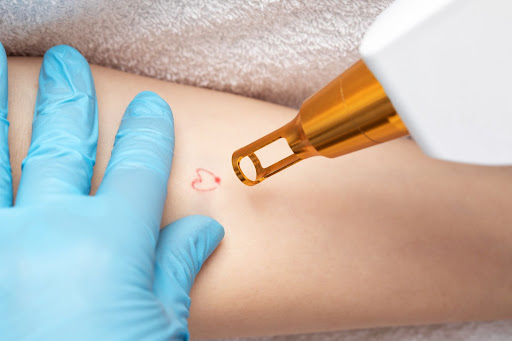 removing tattoos with laser applications